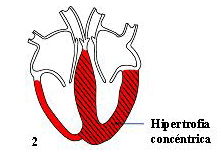 Hipertrofia Simtrica