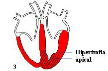 Hipertrofia Apical