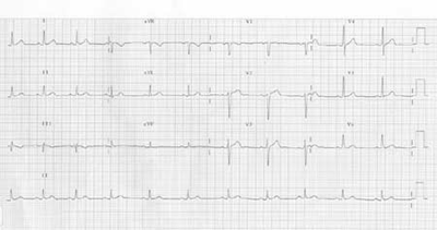 Ejemplo de electrocardiograma normal